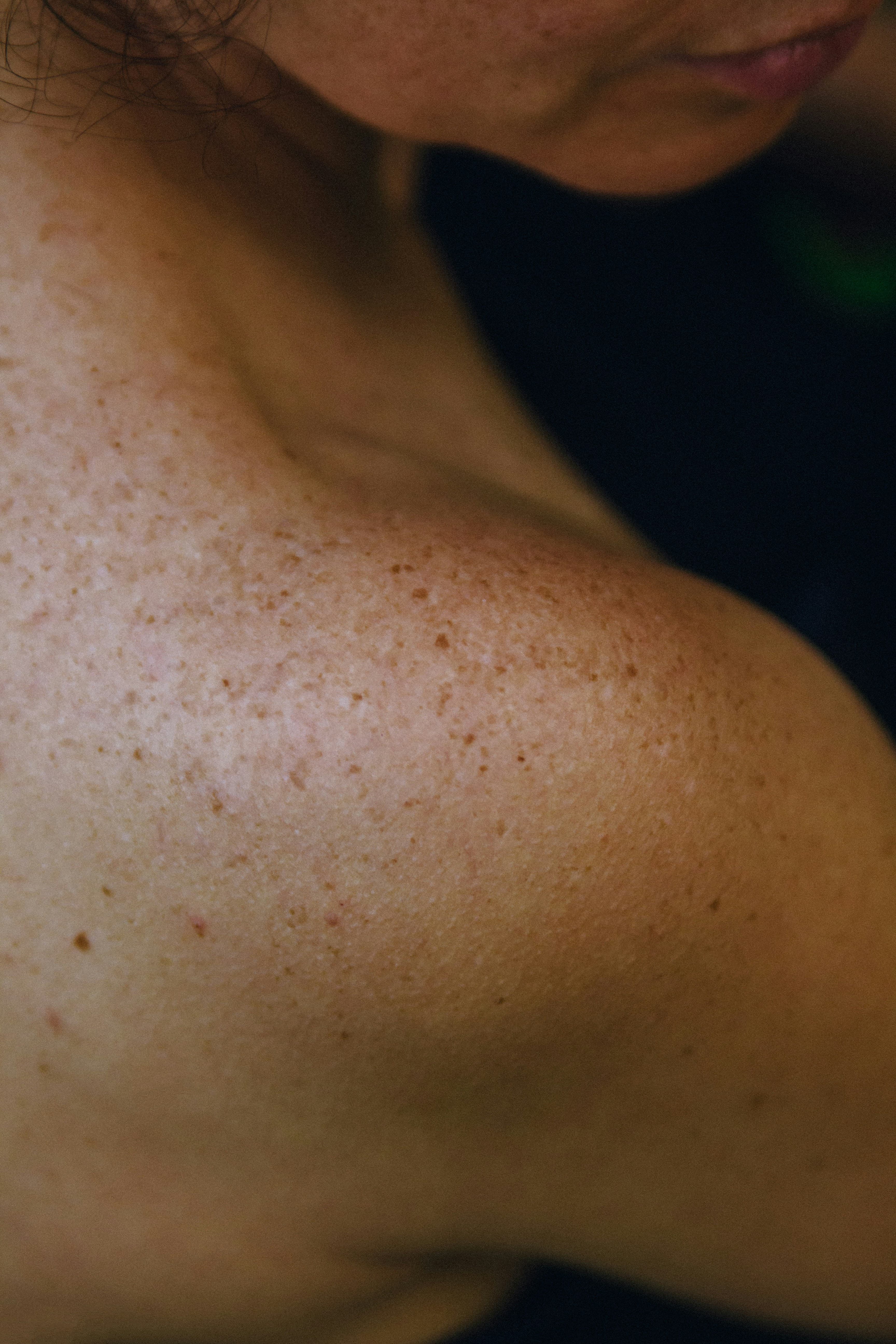 Skin treatment